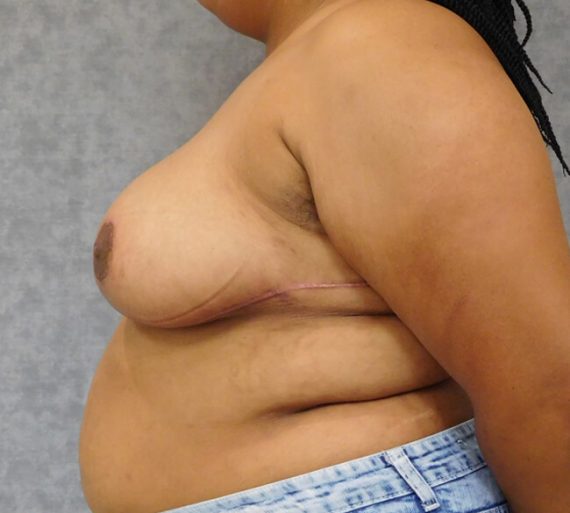 Breast Reduction Patient 11 After