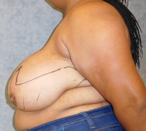 Breast Reduction Patient 11 Before