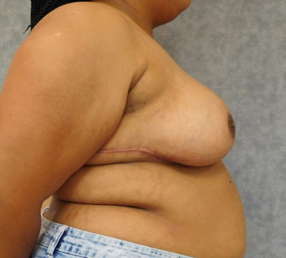Breast Reduction Patient 11 After
