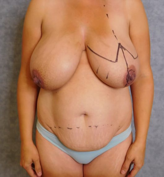Breast Reduction & Mini Tummy Tuck Patient 01 Before