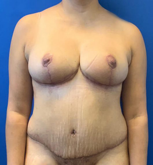 Breast Reduction & Mini Tummy Tuck Patient 02 After