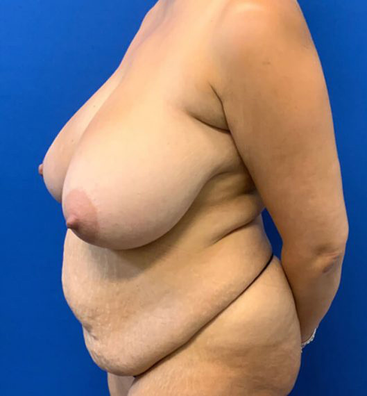 Breast Reduction & Mini Tummy Tuck Patient 02 Before