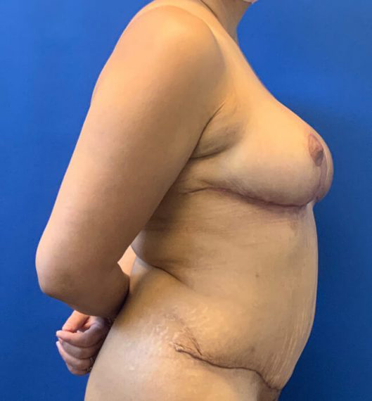 Breast Reduction & Mini Tummy Tuck Patient 02 After