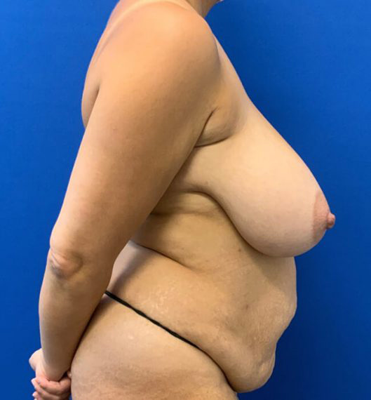 Breast Reduction & Mini Tummy Tuck Patient 02 Before